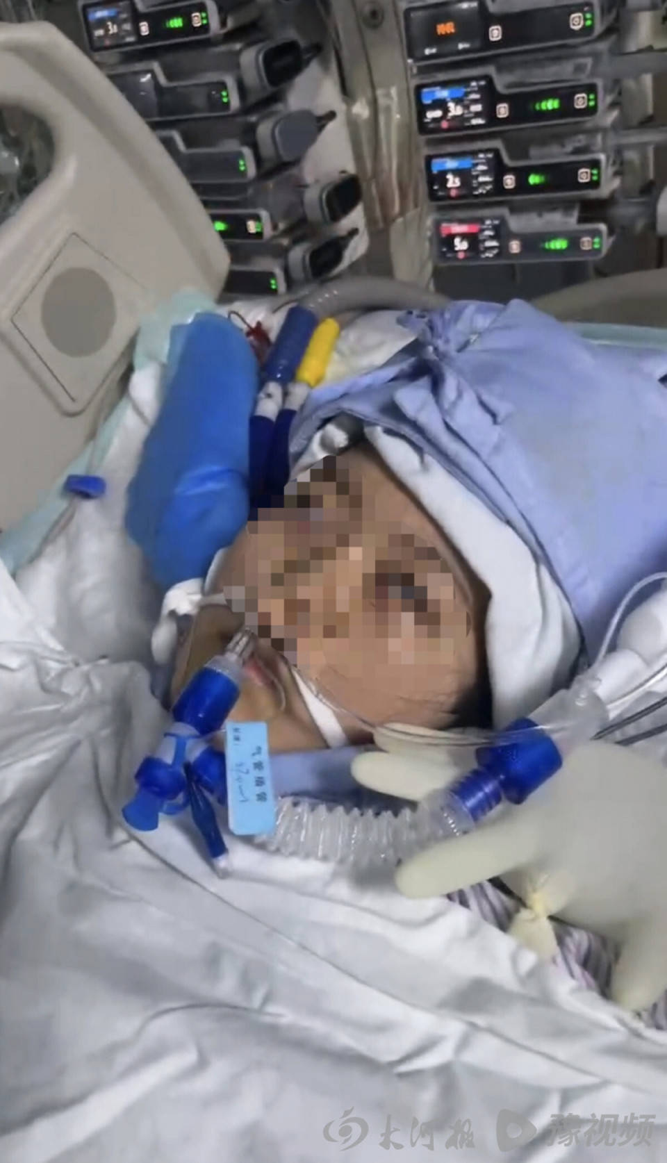 22岁美甲师手术成功却在复苏室脑死亡<strong></p>
<p>币安美元充值</strong>，家属称缺氧30分钟监护医生未察觉，医院回应