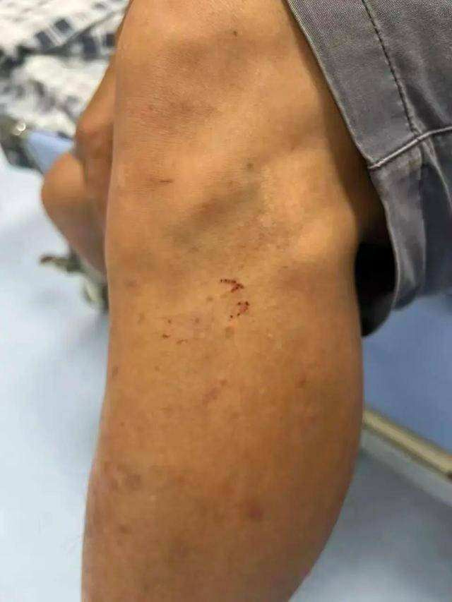 广东62岁阿叔网鱼网到2条眼镜蛇<strong></p>
<p>海外版下载链接</strong>,被咬伤后当场打死,并打包提进医院