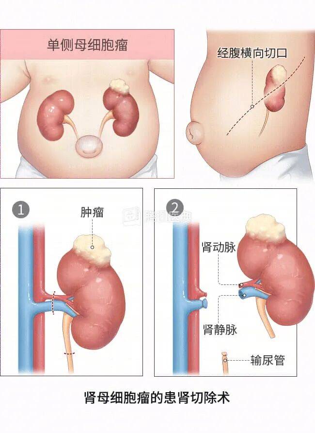 “感觉天塌了”！深圳女孩5岁患癌，爸妈决定：为她冻存卵巢组织