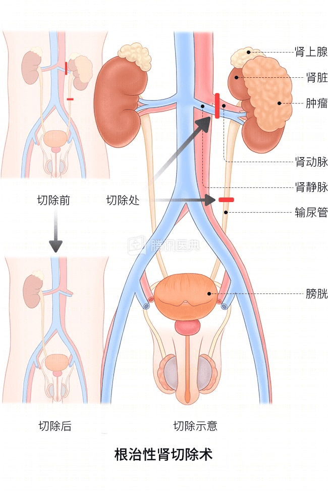 “感觉天塌了”！深圳女孩5岁患癌<strong></p>
<p>葫芦娃股票</strong>，爸妈决定：为她冻存卵巢组织